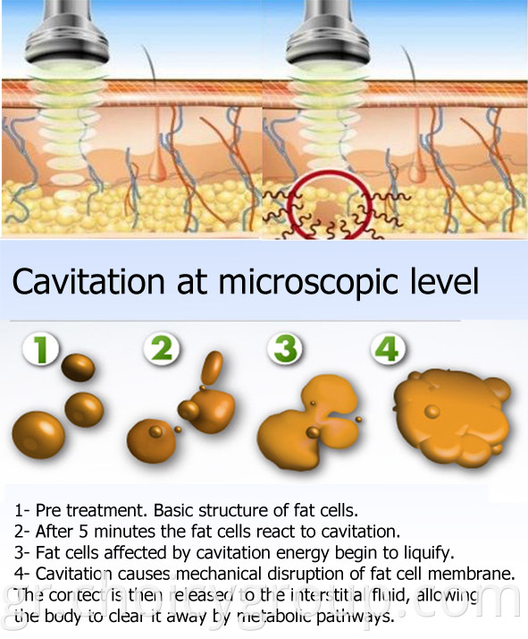 Choicy Cavitation RF Slimming Machine